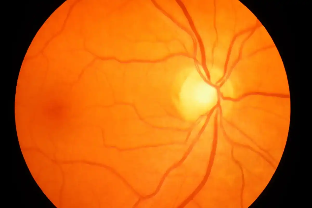 Retinal image used for diabetic eye exam monitoring
